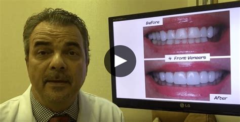 Porc Veneers Vid David Eshom Dds Dental Health And Beauty San Diego Ca