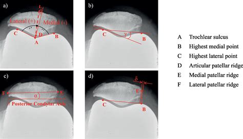 Wiberg Type Iii Patellae And J Sign During Extension Compromise