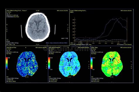 Perfusión Tomografía Computarizada Del Cerebro Imagen de archivo