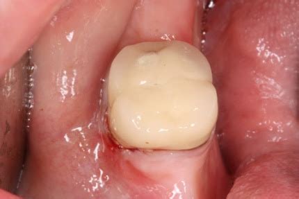 Dental implantology and grafting: Root canal and crown pain