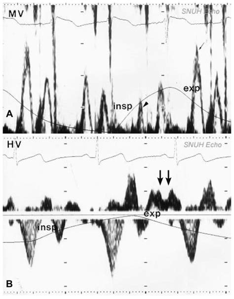 A Mitral Inflow Finding In Constrictive Pericarditis Prominent Download Scientific Diagram