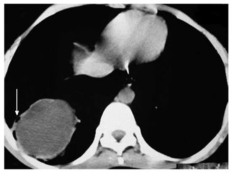 Fluid Around Lung Ct Scan 