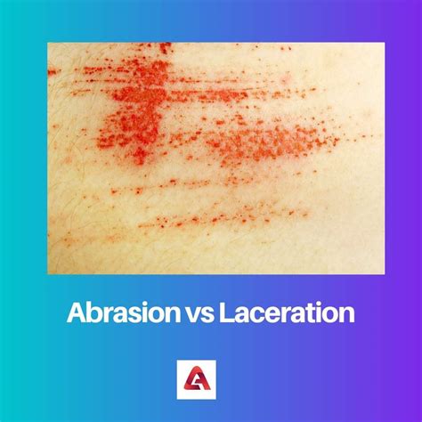 Abrasion Vs Laceration Difference And Comparison