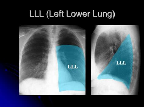 PPT - Chest Radiography Interpretation PowerPoint Presentation, free ...