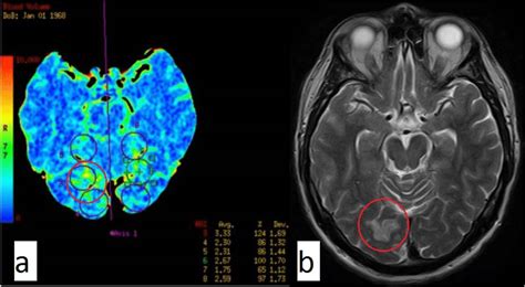 The focus of venous stroke in right occipital lobe (into circle) is ...