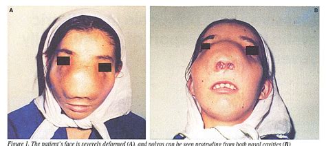 Figure 1 From Massive Nasal Polyposis In Pediatric Cystic Fibrosis