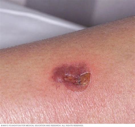 Impetigo Types Symptoms Causes And Treatment Off