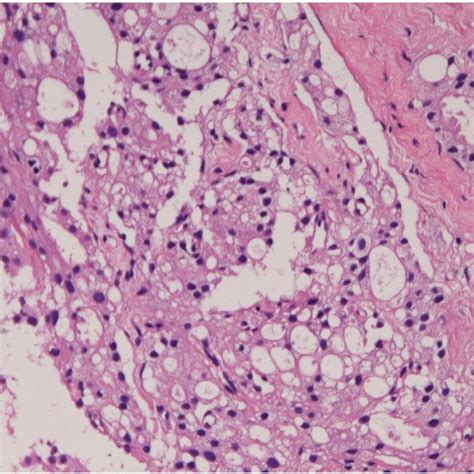 Prostatic Biopsy Revealed An Adenocarcinoma He ×100 Download Scientific Diagram