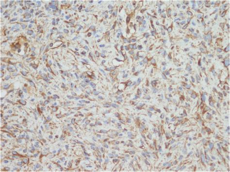 Color Online Immunohistochemistry Stained With Vimentin The Tumor