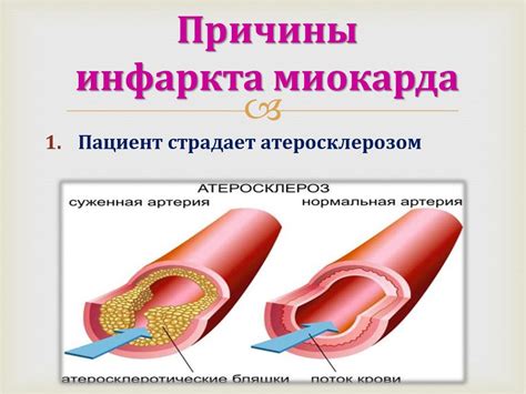 Инфаркт миокарда - презентация онлайн