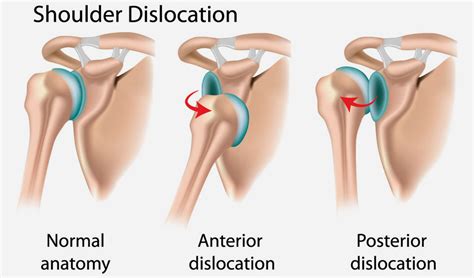 Penyebab Dislokasi Dan Bagaimana Cara Mengobati Galeri Medika