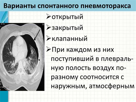 Клинические формы вторичного туберкулеза: ФКТ, цирротический туберкулез ...