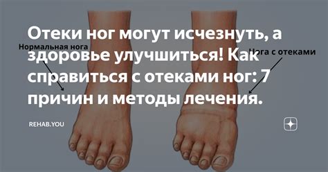 Отеки ног могут исчезнуть, а здоровье улучшиться! Как справиться с ...
