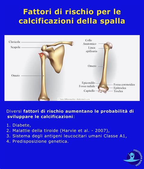 Calcificazione Alla Spalla Le Cause I Sintomi E La Fisioterapia