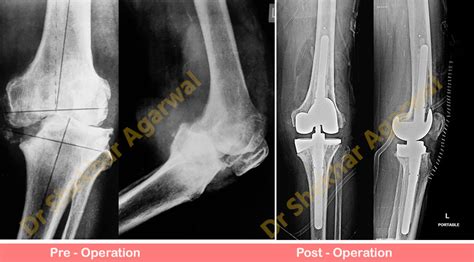 Primary Complex Total Knee Replacement | Sant Parmanand Hospital