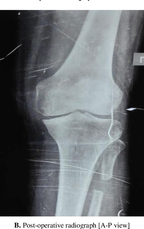 Figure From A Clinical Study On Management Of Medial Compartment Knee