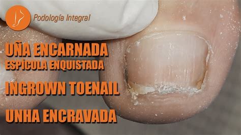 Uña encarnada Espícula enquistada Ingrown toenail Unha encravada