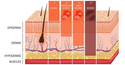 Identifying a Severe Burn - Beaumont Emergency Center