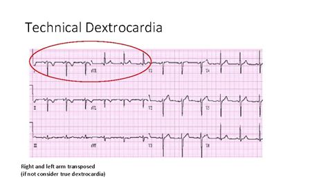 Module 1 Introduction To Ecg Normal Ecg Importance