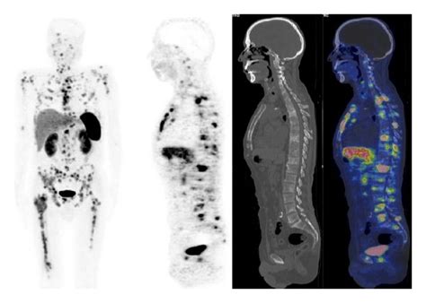 Ga Dotatoc Pet Ct Images Mip Sagittal In A Patient With Metastatic