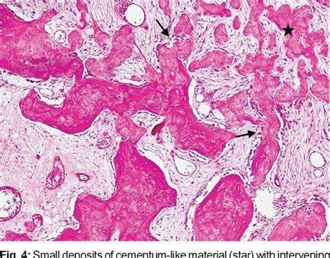 Simple Bone Cyst Histology