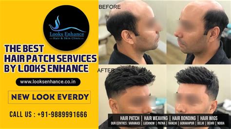 Mens Hair Patch Patna Hair Weaving In Patna Hair Bonding In Patna