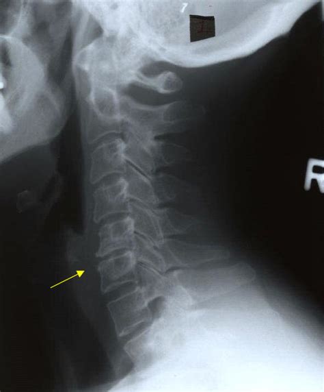 Osteophyte Formation In Cervical Spinesymptomstreatment