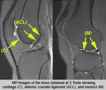 Musculoskeletal Radiology MSK UCSF Radiology