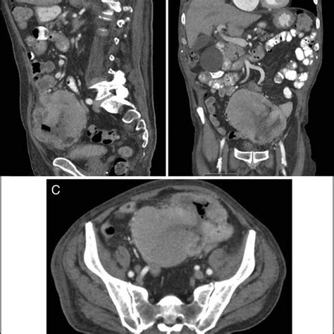 A Sagittal B Coronal And C Axial View Of The Abdominal Computed