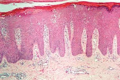 Histologia De Lesão Psoriática Download Scientific Diagram