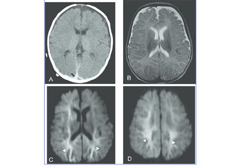 Injury Pattern Predominantly Hypoxic Ischemic Injury Hii Lesions