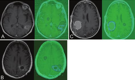 Axial T Weighted Mr Images Volumetric Method Shown On The Right A