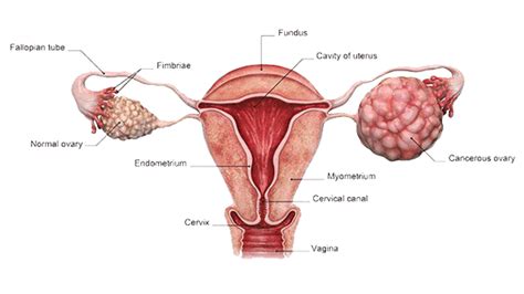 Cancertame® | Ovarian Cancer (Stromal, Germ Cell and Krukenberg's Tumour)