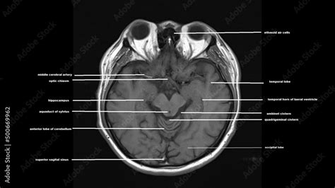 Normal Brain Anatomy Axial T1weighted Mri Images Stock Photo Adobe Stock