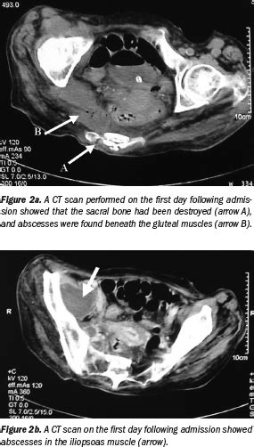 Iliopsoas Muscle Abscess Secondary To Sacral Pressure Ulcer Treated