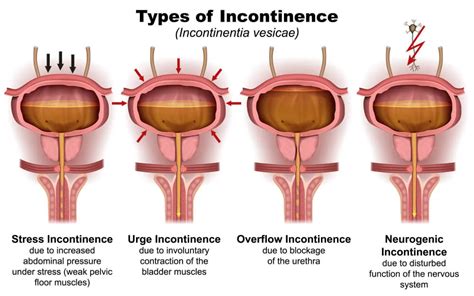 Urinary Incontinence Causes Symptoms And Natural Treatments Annex