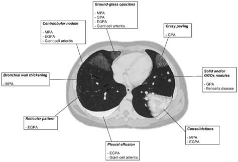 Diagnostics Free Full Text Pulmonary Vasculitides A Radiological Review Emphasizing