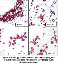 Pathology Outlines Intrathyroidal Thymic Carcinoma