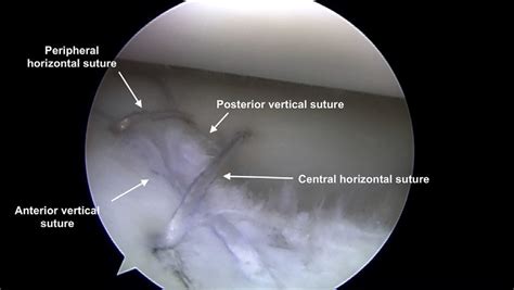 Right Knee Lateral Meniscus After Passage Of 2 Sets Of Meniscus Needles