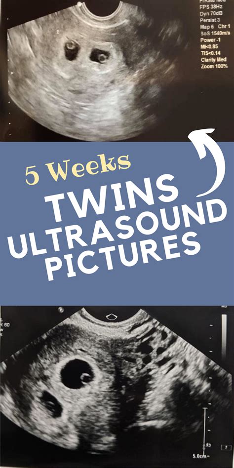 Twin Pregnancy Week By Week Timeline Artofit