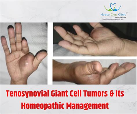 Tenosynovial Giant Cell Tumors Its Homeopathic Management Homeo