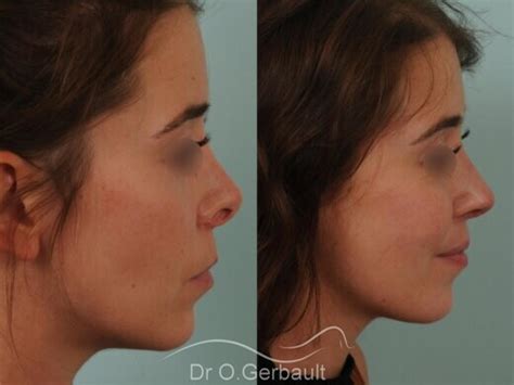 Rhinoplastie Avant Apr S Photos Et Exemples De Nez Refaits