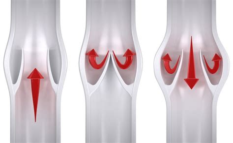 Ischemic Wounds