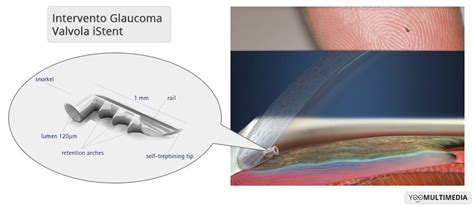 Intervento Glaucoma Trabeculectomia Impianto Drenante Iridotomia Laser