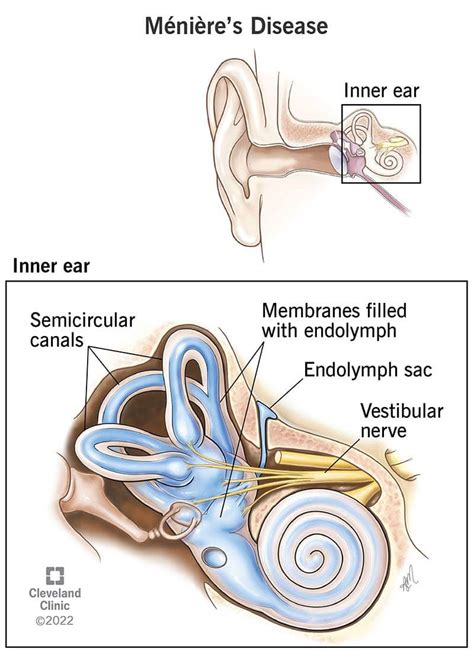 Ménière’s Disease Symptoms Causes And Treatment