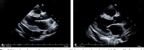 Figure 1 from A case of a pericardial window procedure performed by ...