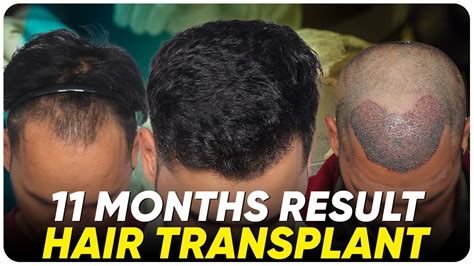 Hair Transplant In Iran Best Results And Cost Of Hair Transplant In Iran Youtube