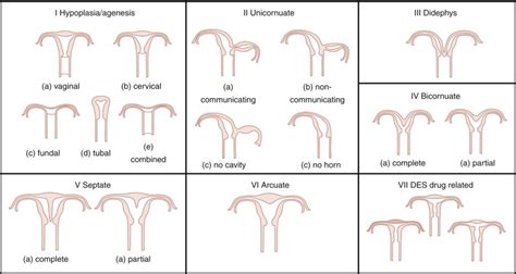 Müllerian Uterine Anomalies | Radiology Key