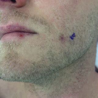 penetrating facial injury   airsoft pellet  case report