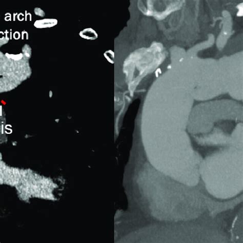 Preoperative Computed Tomography Angiography Showing A Huge Aortic